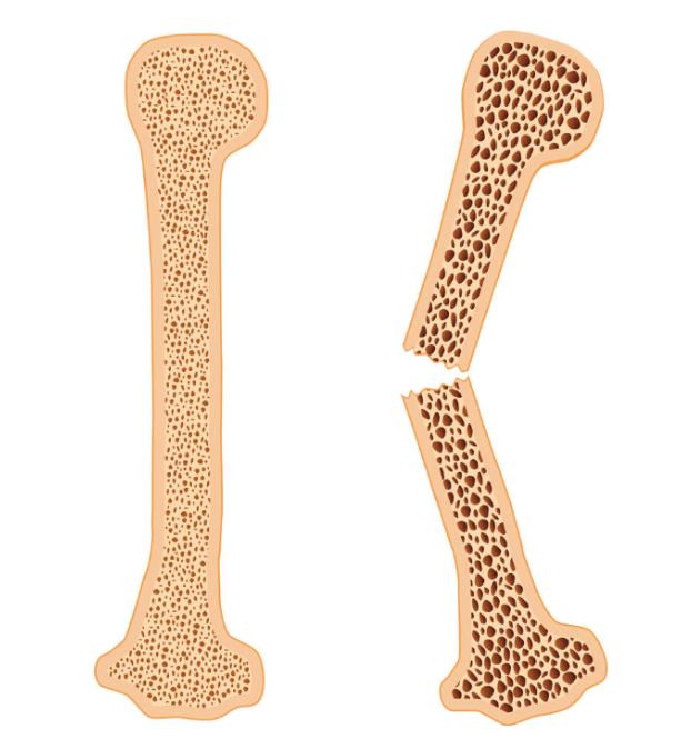 今日关注-从超声波骨密度检测仪检测骨量多少来预测骨折风险