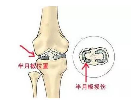 624河南信阳|国康超声波骨密度仪厂家今日资讯:了解并正确保护膝关节半月板