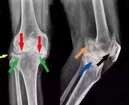 国康便携式骨密度检测仪提醒您得了骨质增生要怎么办?-江苏南京