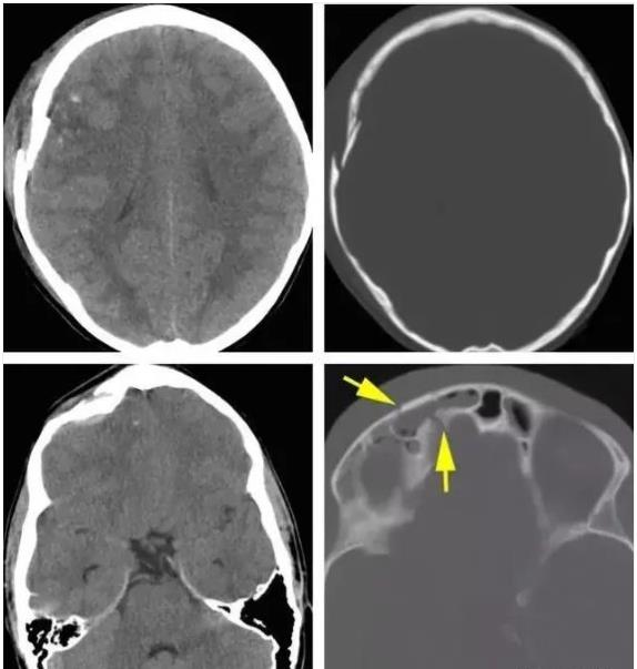 SDGK骨密度检测仪常见问题-颅骨骨折应该怎么班呢?