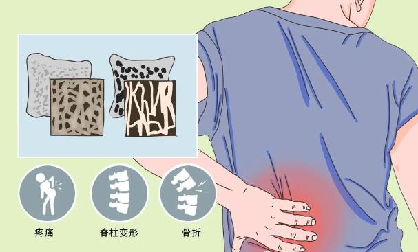 便携式骨密度检测仪厂家带您了解骨密度检测的意义、适宜人群及注意事项!